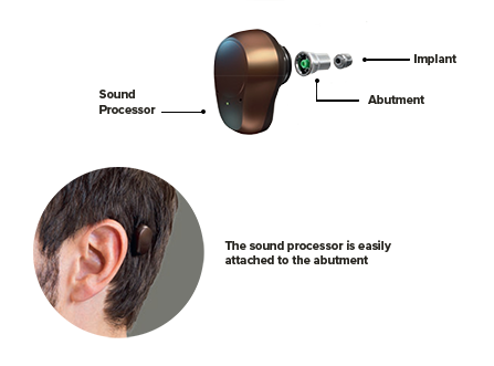 Diagram of a Bone Anchor Implant - showing how the sound processor is easily attached to the abutment