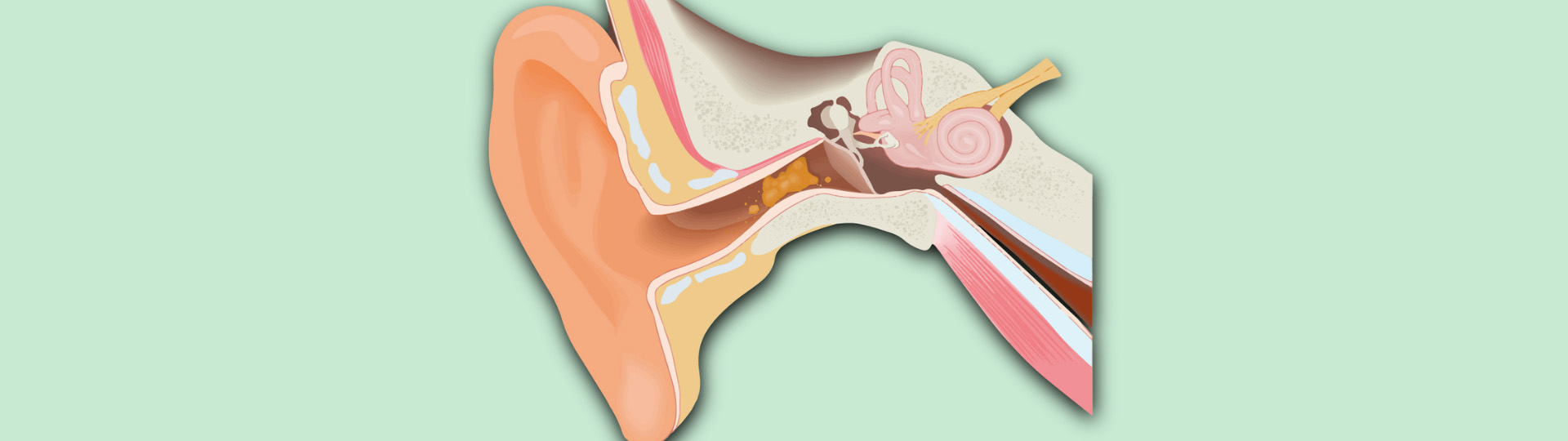 Cross-section of the human ear displaying earwax accumulation in the ear canal.