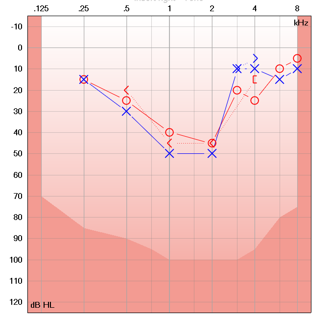 audiogram showing a cookie bite, or mid-frequency loss