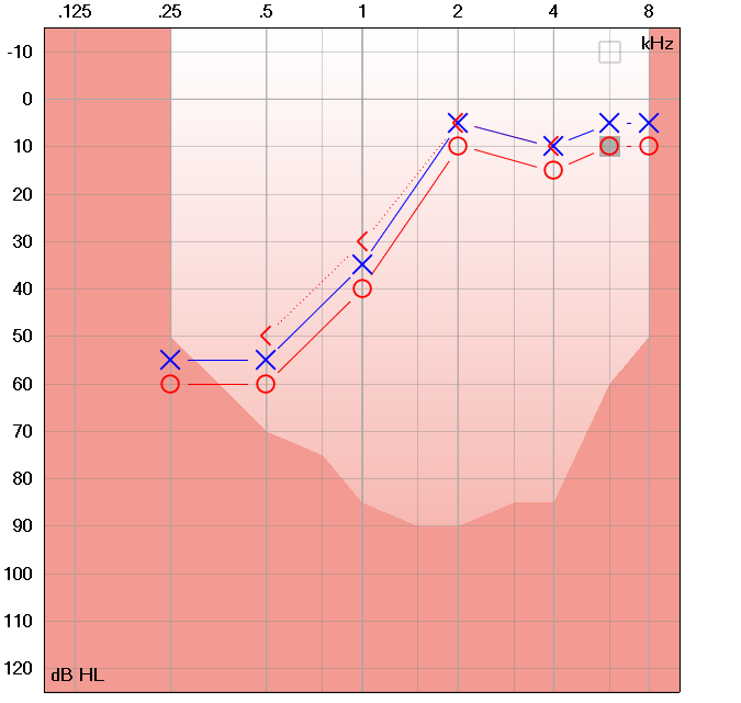 audiogram showing low frequency hearing loss
