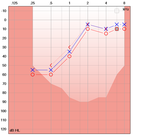 audiogram showing low frequency hearing loss