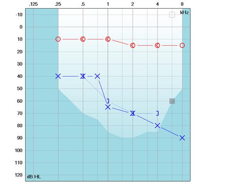 one sided hearing loss on an audiogram