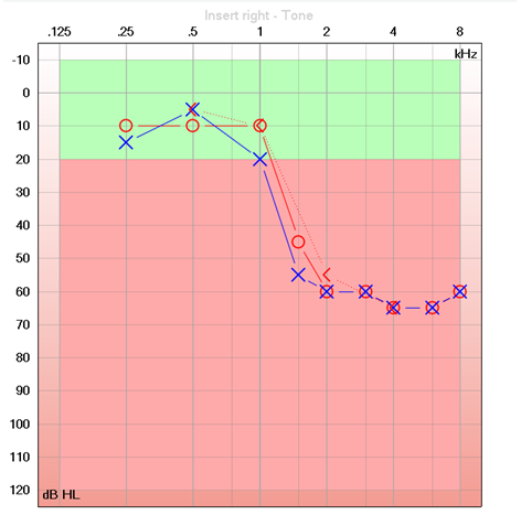 high frequency loss on an audiogram