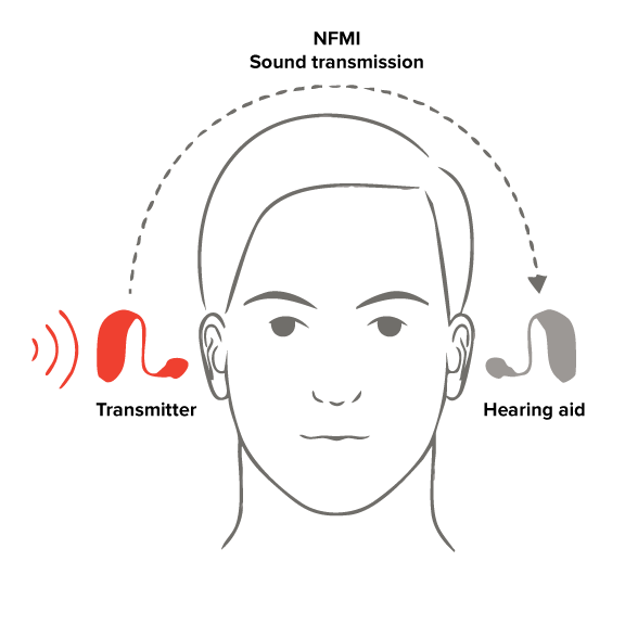 A transmitter with a microphone that wirelessly picks up and sends the sound from your poorer ear to the better ear.