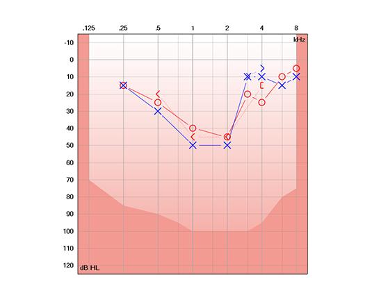 audiogram illustrating a cookie bite hearing loss pattern