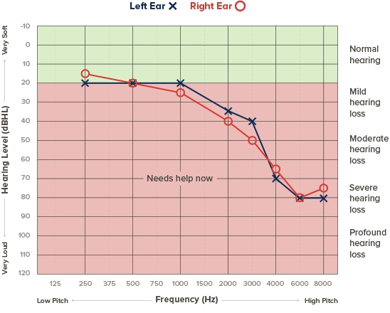 A hearing test graph (audiogram) compares hearing levels (dBHL) of the left ear (blue X) and right ear (red O) across frequencies (125 Hz to 8000 Hz). The chart categorizes hearing into normal, mild, moderate, severe, and profound loss, indicated by colored bands. Both ears show severe hearing loss at higher frequencies, suggesting 'Needs help now.' Text includes:  

- Left Ear X  
- Right Ear O  
- Normal Hearing  
- Mild Hearing Loss  
- Moderate Hearing Loss  
- Severe Hearing Loss  
- Profound Hearing Loss  
- Needs help now