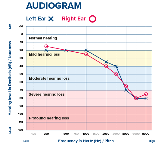 Audiogram chart showing left and right ear hearing thresholds across frequencies, highlighting varying degrees from normal hearing to profound hearing loss.